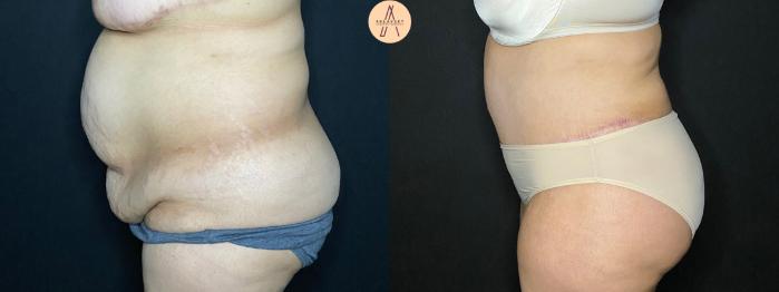 Before & After Tummy Tuck Case 118 Left Side View in San Antonio, Texas