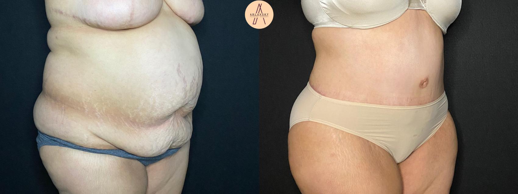 Before & After Tummy Tuck Case 118 Right Oblique View in San Antonio, Texas