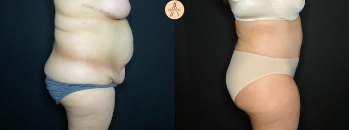 Before & After Tummy Tuck Case 118 Right Side View in San Antonio, Texas