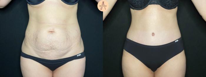 Before & After Tummy Tuck Case 122 Front View in San Antonio, Texas