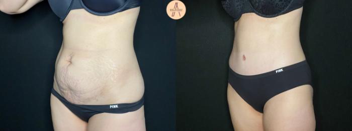Before & After Tummy Tuck Case 122 Left Oblique View in San Antonio, Texas