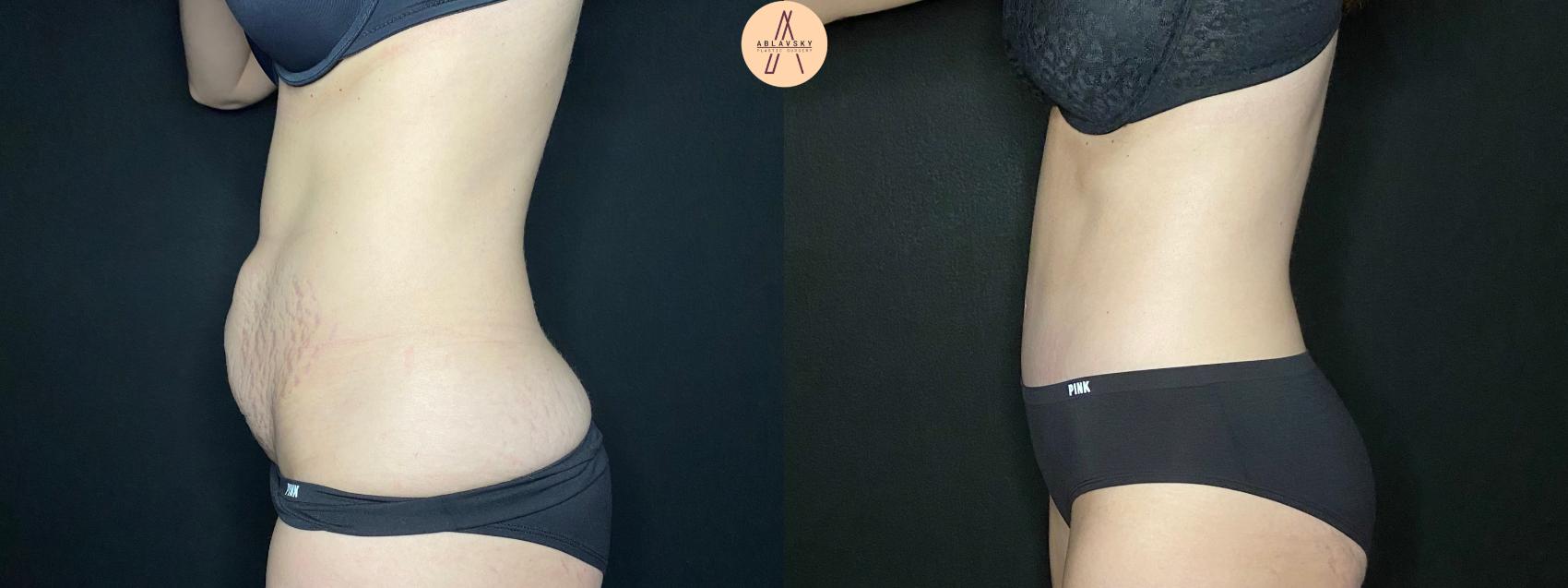 Before & After Tummy Tuck Case 122 Left Side View in San Antonio, Texas