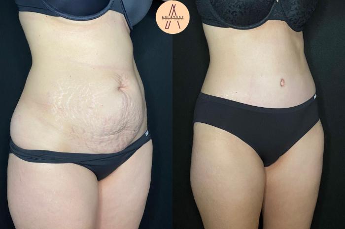 Before & After Tummy Tuck Case 122 Right Oblique View in San Antonio, Texas