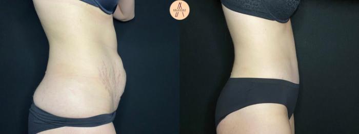 Before & After Tummy Tuck Case 122 Right Side View in San Antonio, Texas