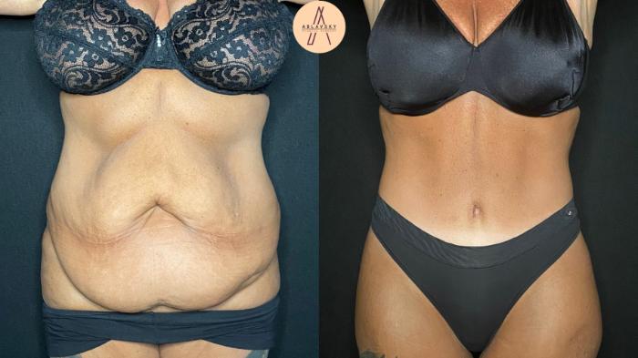 Before & After Tummy Tuck Case 126 Front View in San Antonio, Texas