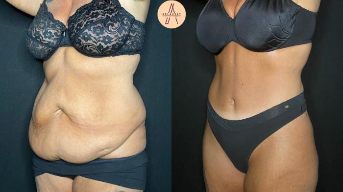 Before & After Tummy Tuck Case 126 Left Oblique View in San Antonio, Texas