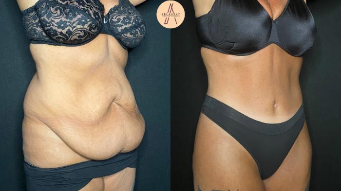 Before & After Liposuction Case 126 Right Oblique View in San Antonio, Texas