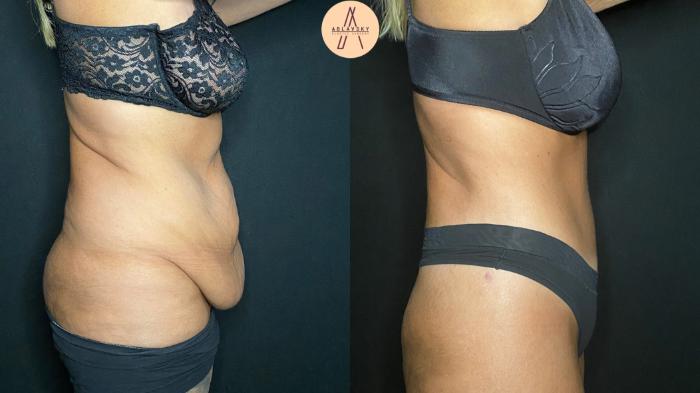 Before & After Liposuction Case 126 Right Side View in San Antonio, Texas