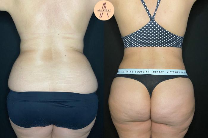 Before & After Tummy Tuck Case 127 Back View in San Antonio, Texas