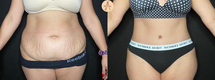 Before & After Tummy Tuck Case 127 Front View in San Antonio, Texas