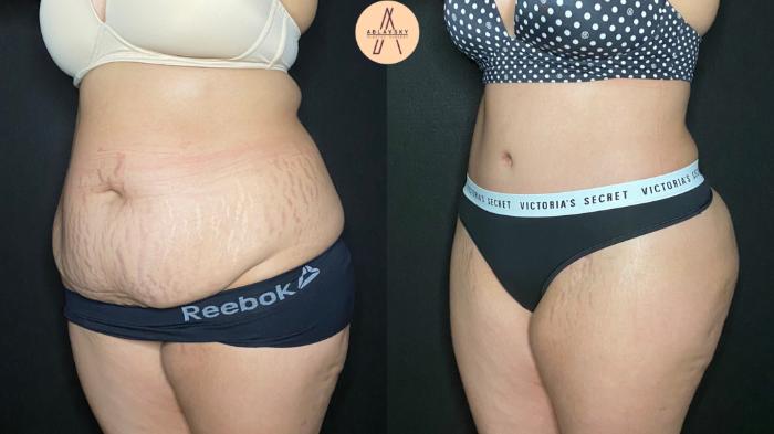 Before & After Tummy Tuck Case 127 Left Oblique View in San Antonio, Texas