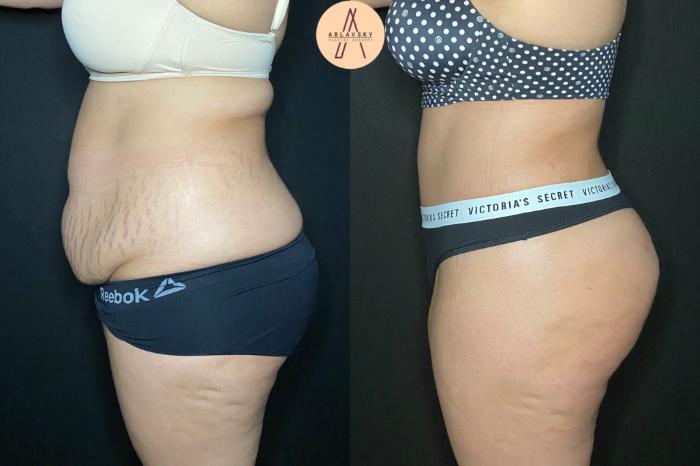 Before & After Tummy Tuck Case 127 Left Side View in San Antonio, Texas