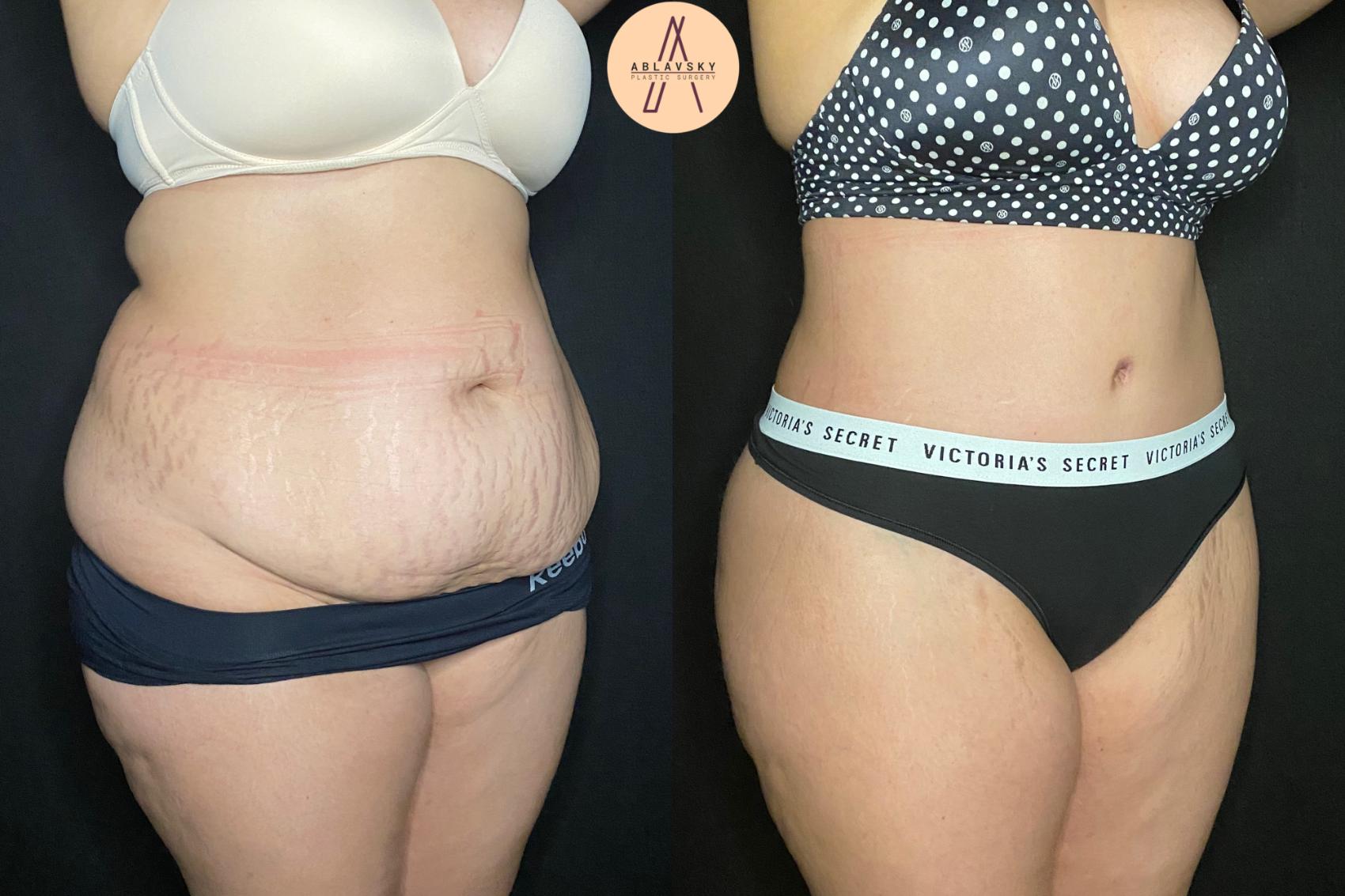 Before & After Tummy Tuck Case 127 Right Oblique View in San Antonio, Texas