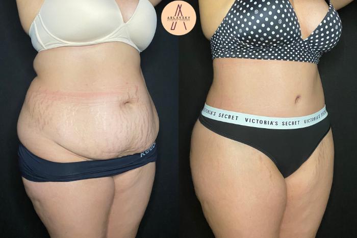 Before & After Tummy Tuck Case 127 Right Oblique View in San Antonio, Texas