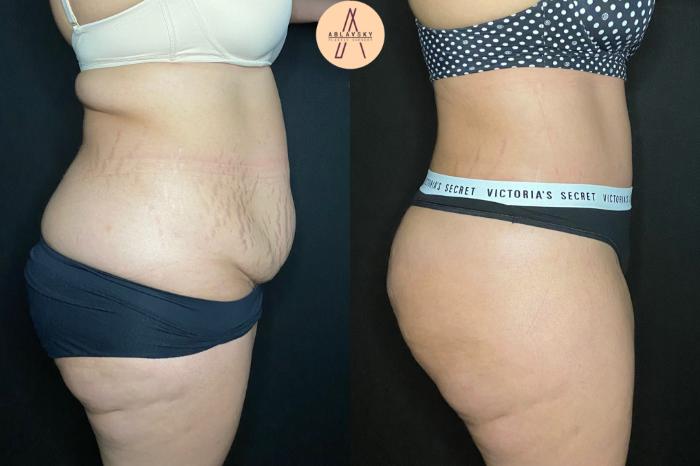 Before & After Tummy Tuck Case 127 Right Side View in San Antonio, Texas