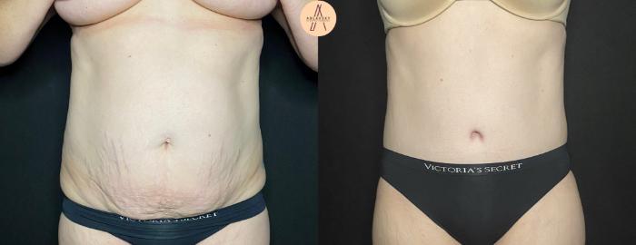 Before & After Tummy Tuck Case 128 Front View in San Antonio, Texas