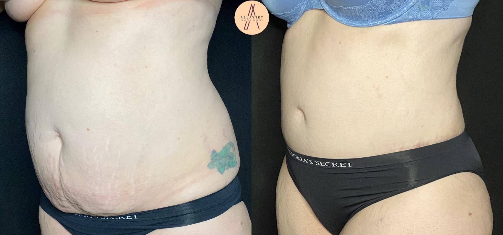 Before & After Tummy Tuck Case 128 Left Oblique View in San Antonio, Texas