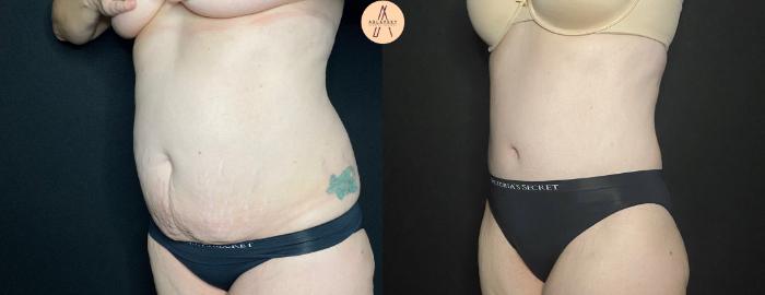 Before & After Tummy Tuck Case 128 Left Oblique View in San Antonio, Texas
