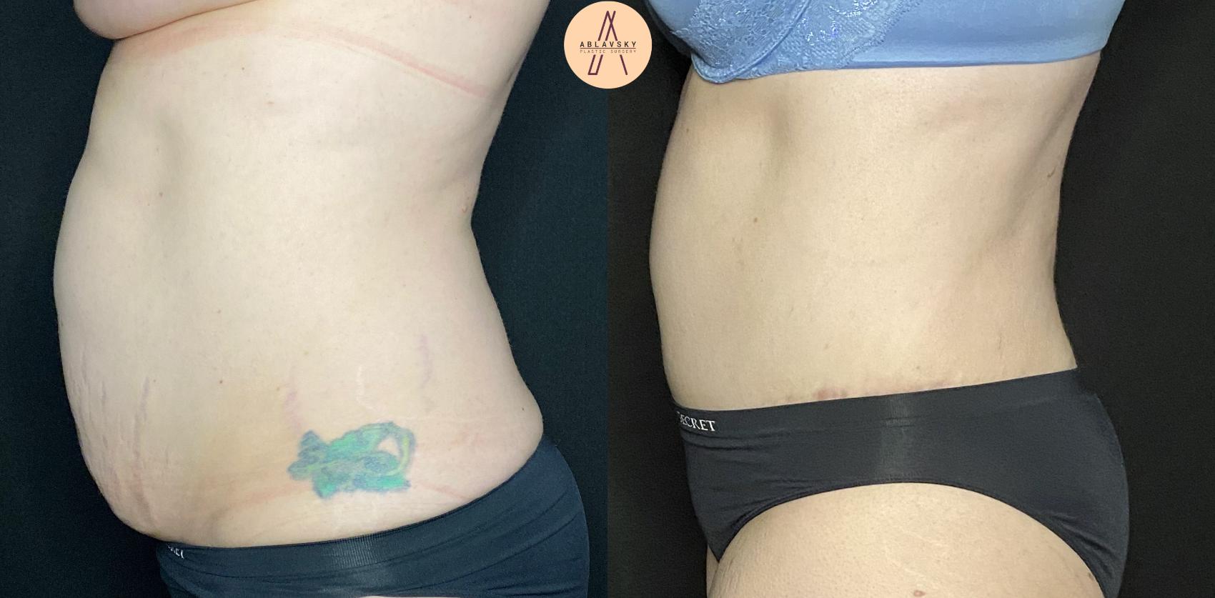 Before & After Tummy Tuck Case 128 Left Side View in San Antonio, Texas