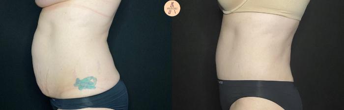 Before & After Tummy Tuck Case 128 Left Side View in San Antonio, Texas