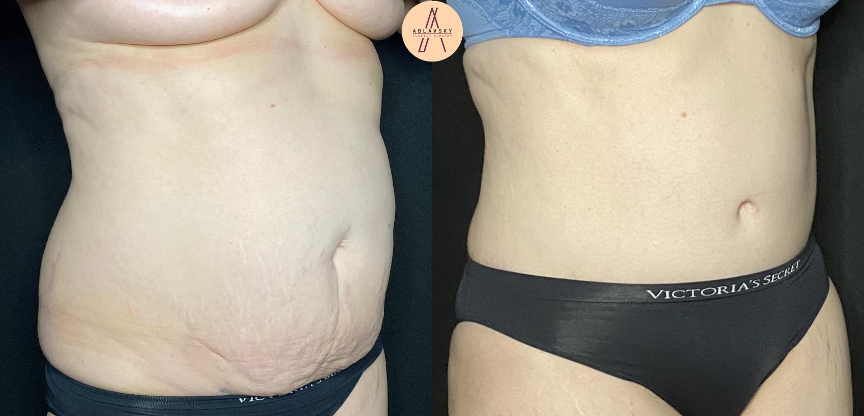 Before & After Tummy Tuck Case 128 Right Oblique View in San Antonio, Texas