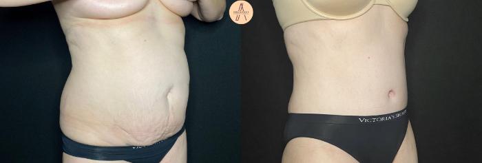 Before & After Tummy Tuck Case 128 Right Oblique View in San Antonio, Texas