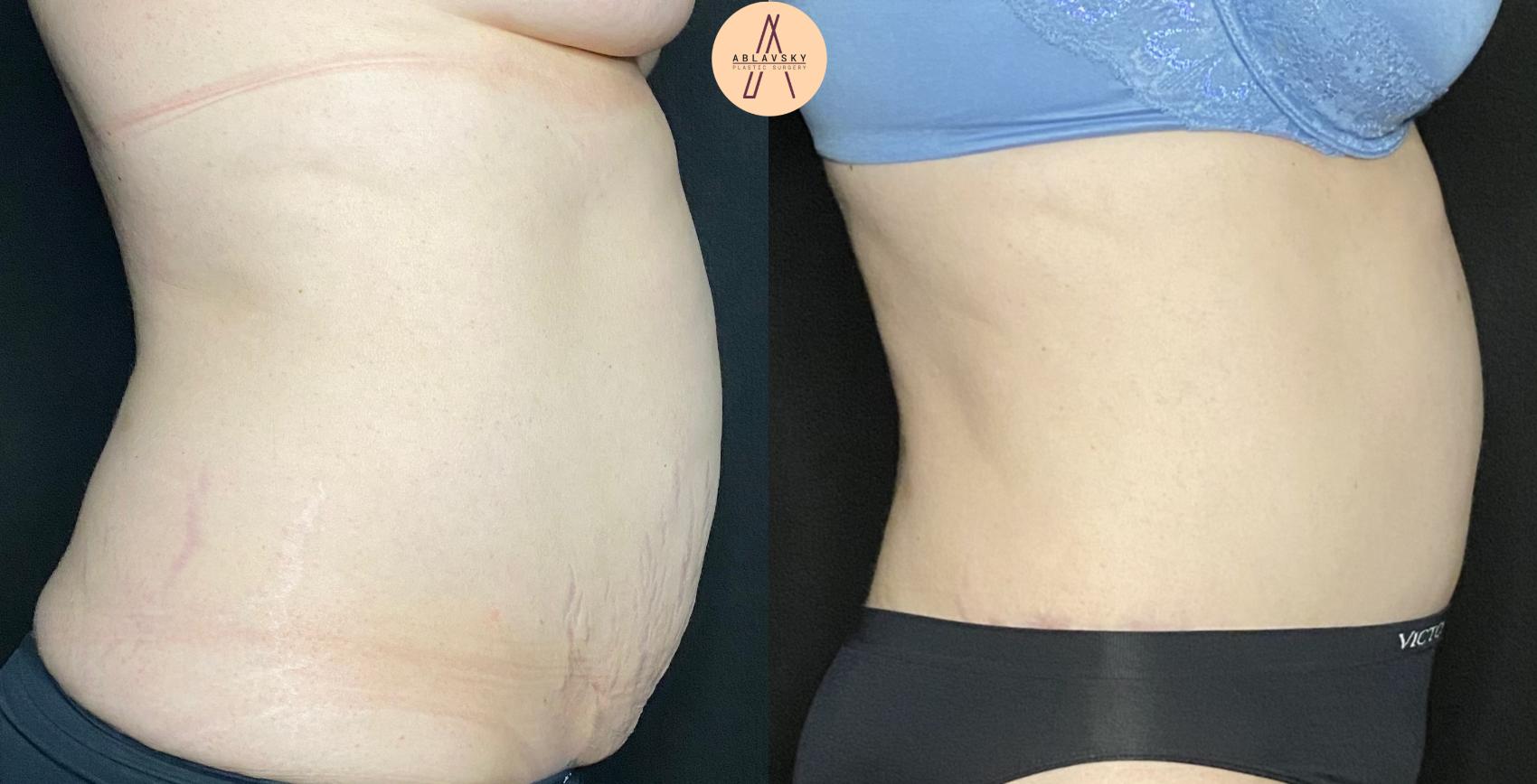 Before & After Tummy Tuck Case 128 Right Side View in San Antonio, Texas