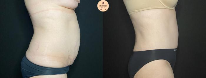 Before & After Tummy Tuck Case 128 Right Side View in San Antonio, Texas