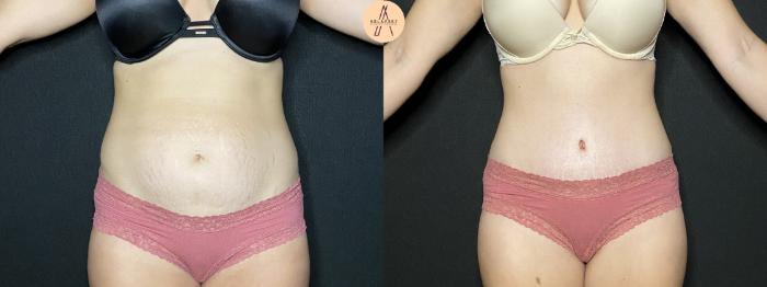 Before & After Tummy Tuck Case 135 Front View in San Antonio, Texas