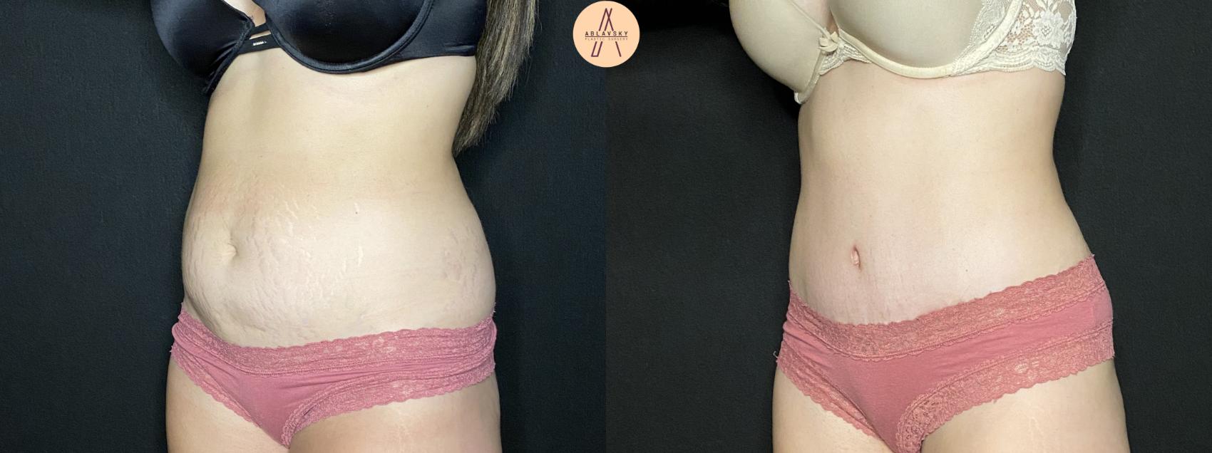 Before & After Tummy Tuck Case 135 Left Oblique View in San Antonio, Texas