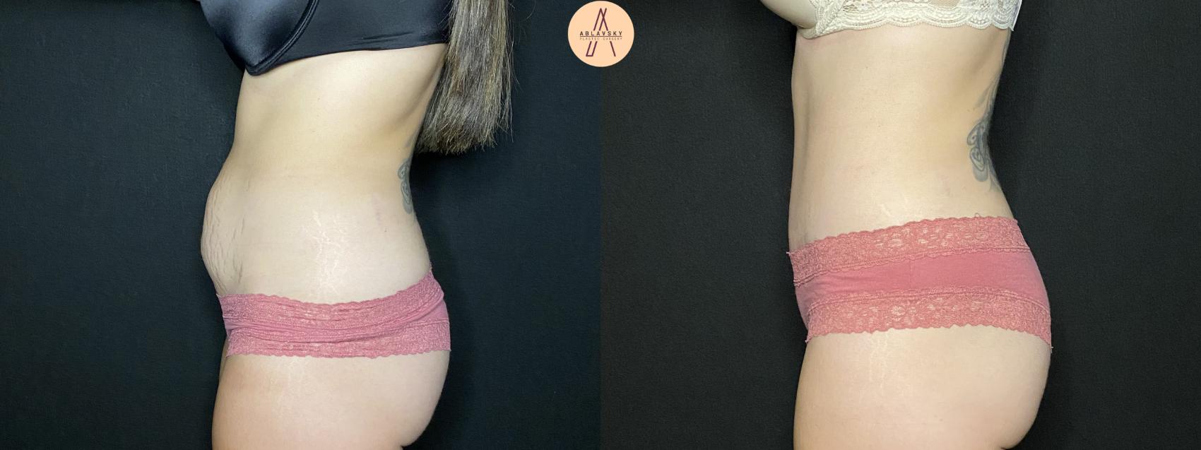 Before & After Tummy Tuck Case 135 Left Side View in San Antonio, Texas