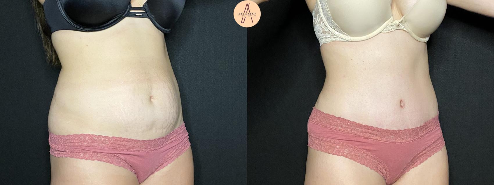 Before & After Tummy Tuck Case 135 Right Oblique View in San Antonio, Texas