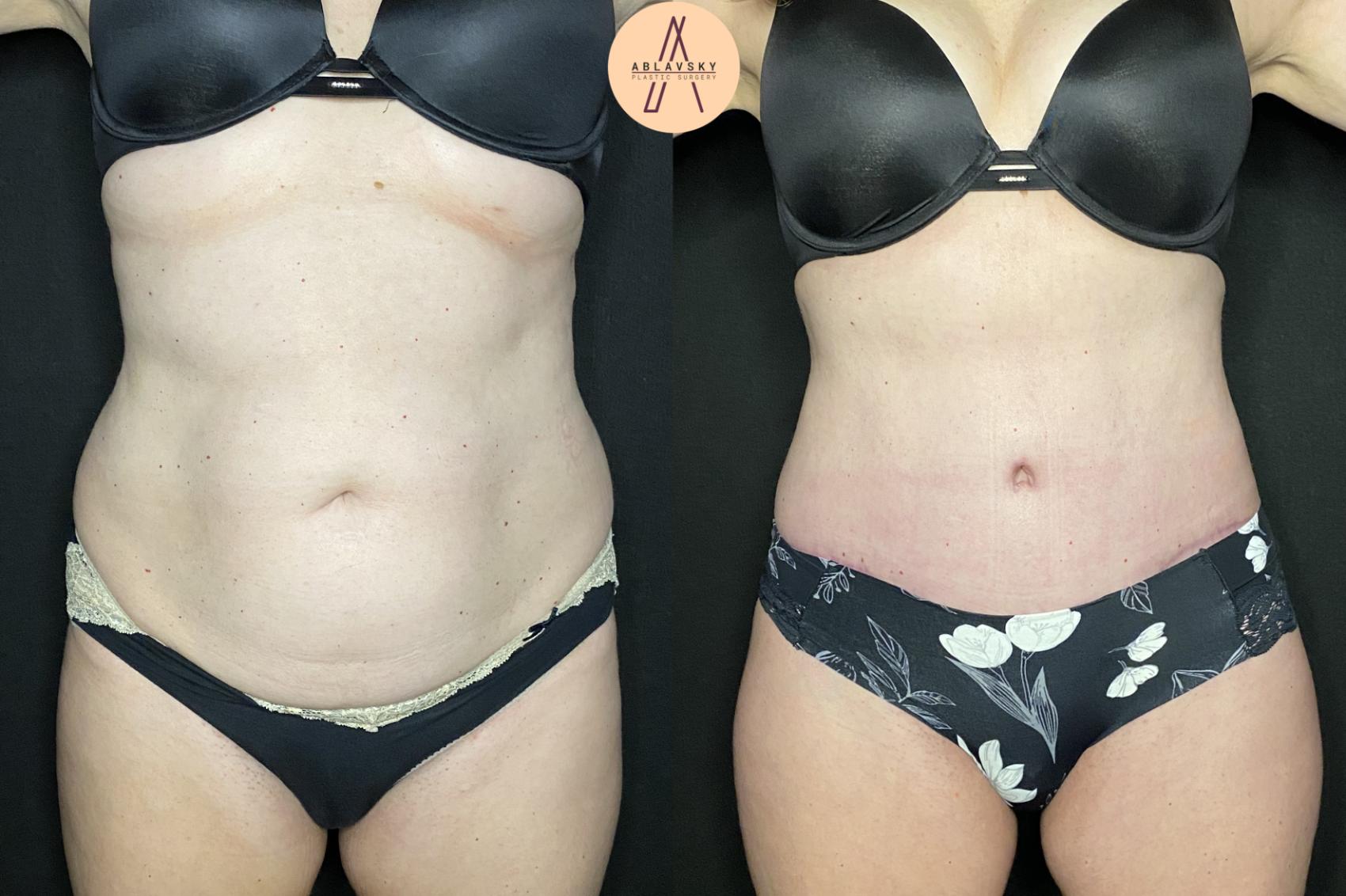 Before & After Tummy Tuck Case 143 Front View in San Antonio, Texas