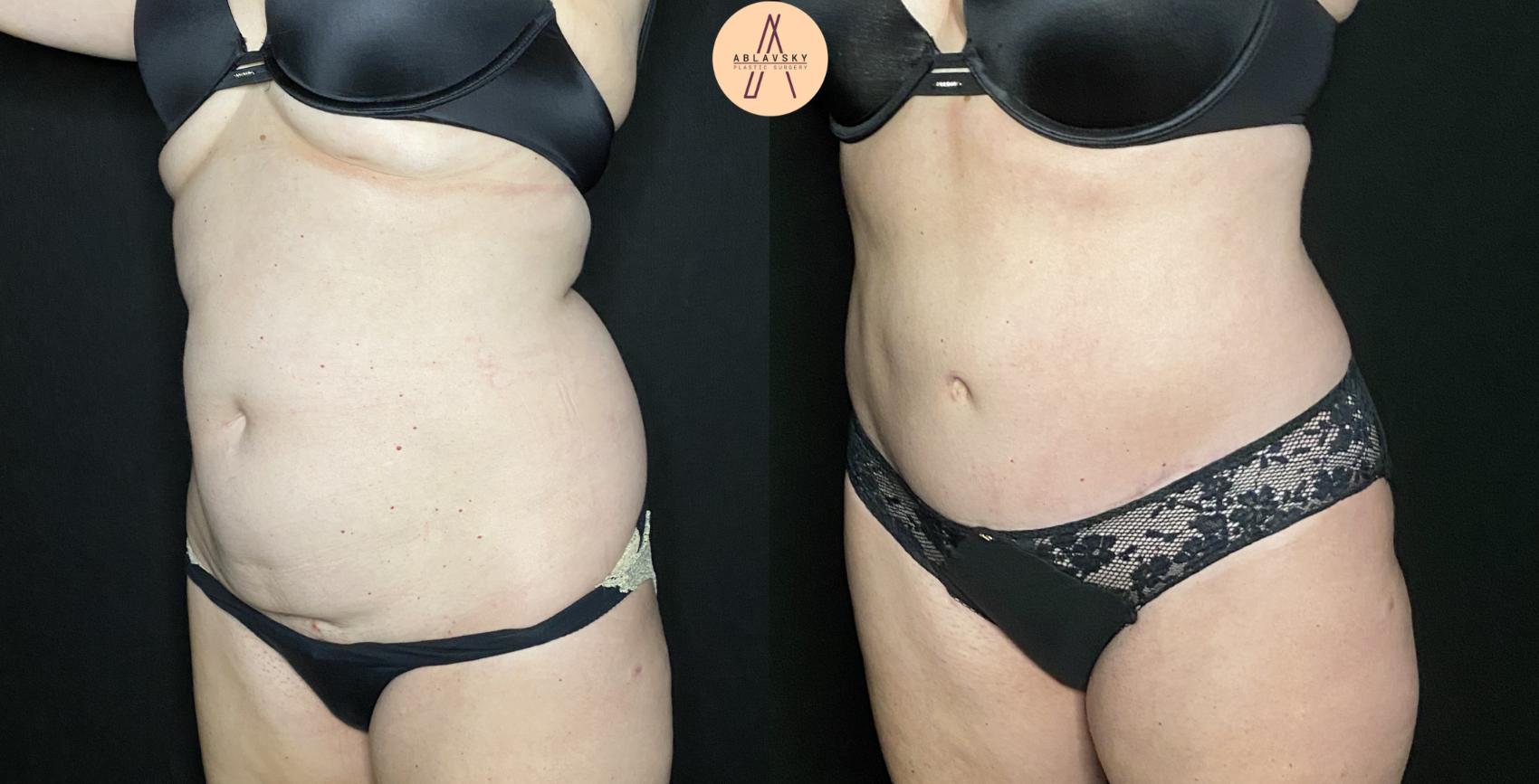 Before & After Tummy Tuck Case 143 Left Oblique View in San Antonio, Texas