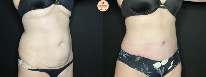 Before & After Tummy Tuck Case 143 Right Oblique View in San Antonio, Texas