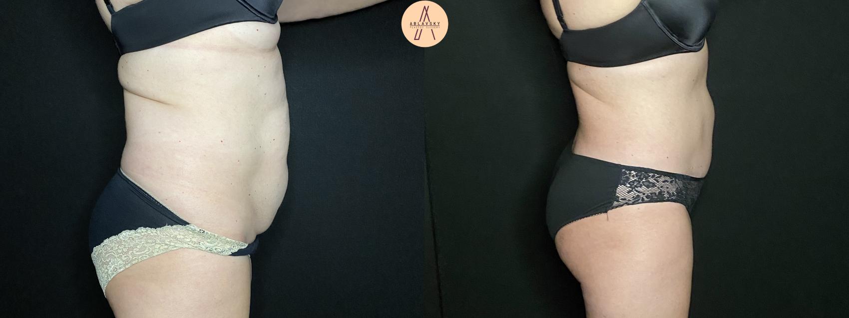 Before & After Tummy Tuck Case 143 Right Side View in San Antonio, Texas