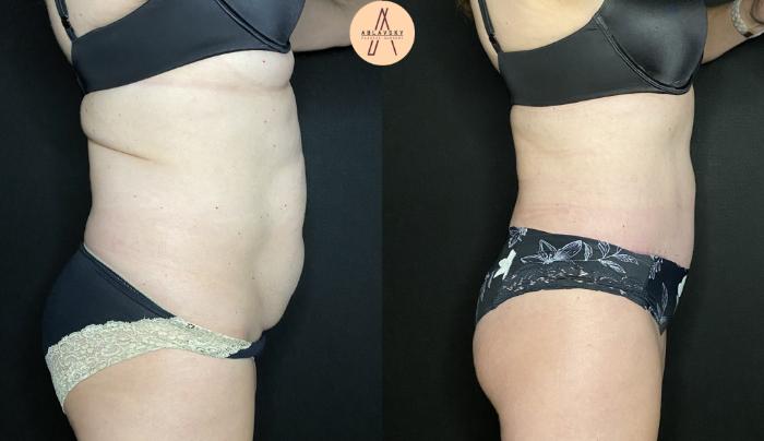 Before & After Tummy Tuck Case 143 Right Side View in San Antonio, Texas