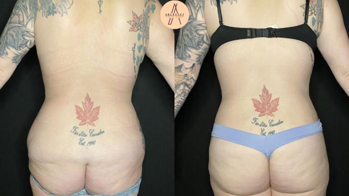 Before & After Liposuction Case 153 Back View in San Antonio, Texas