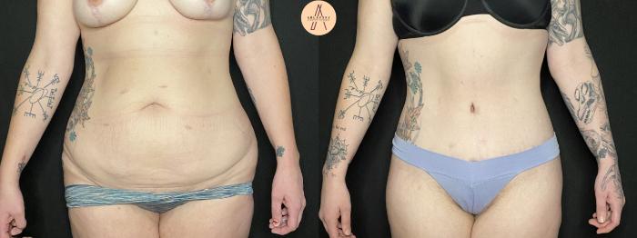 Before & After Liposuction Case 153 Front View in San Antonio, Texas