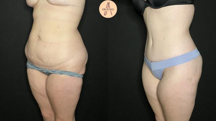Before & After Tummy Tuck Case 153 Left Oblique View in San Antonio, Texas
