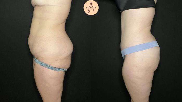 Before & After Tummy Tuck Case 153 Left Side View in San Antonio, Texas