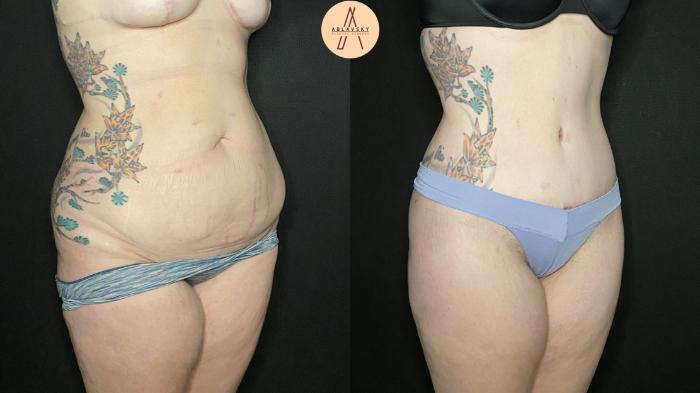 Before & After Tummy Tuck Case 153 Right Oblique View in San Antonio, Texas