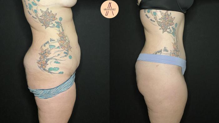 Before & After Liposuction Case 153 Right Side View in San Antonio, Texas