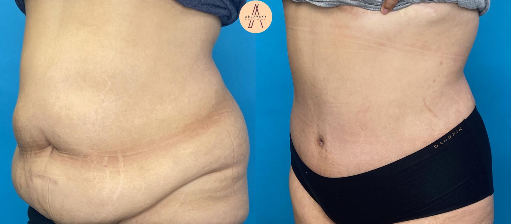 Abdominoplasty - oblique