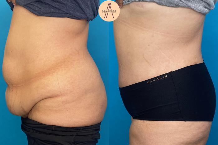 Before & After Tummy Tuck Case 16 Left Side View in San Antonio, Texas