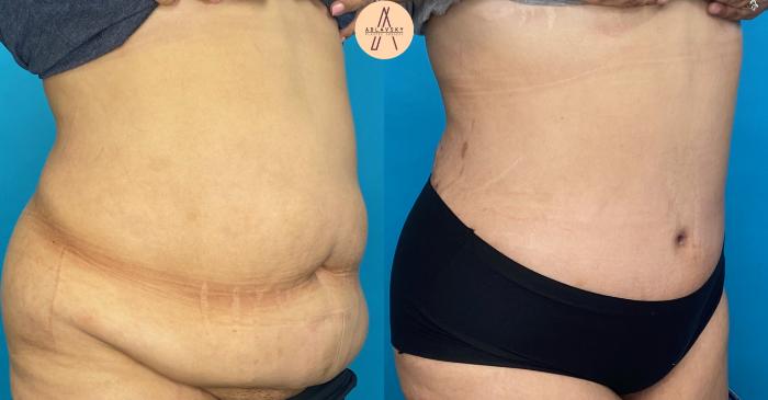 Before & After Tummy Tuck Case 16 Right Oblique View in San Antonio, Texas