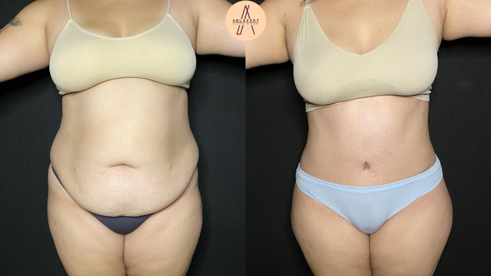 Before & After Tummy Tuck Case 161 Front View in San Antonio, Texas