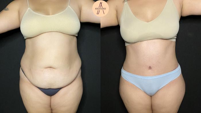 Before & After Liposuction Case 161 Front View in San Antonio, Texas
