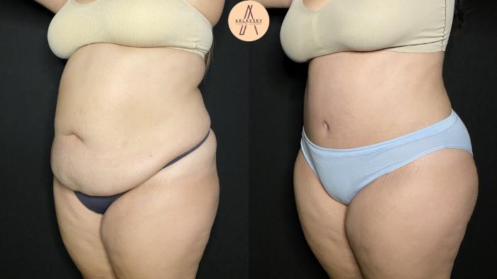 Before & After Tummy Tuck Case 161 Left Oblique View in San Antonio, Texas