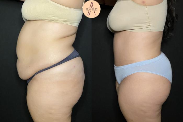 Before & After Liposuction Case 161 Left Side View in San Antonio, Texas